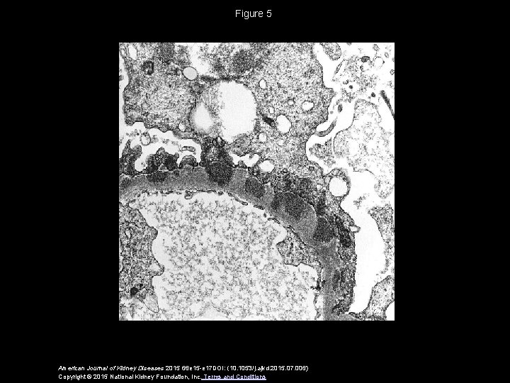 Figure 5 American Journal of Kidney Diseases 2015 66 e 15 -e 17 DOI: