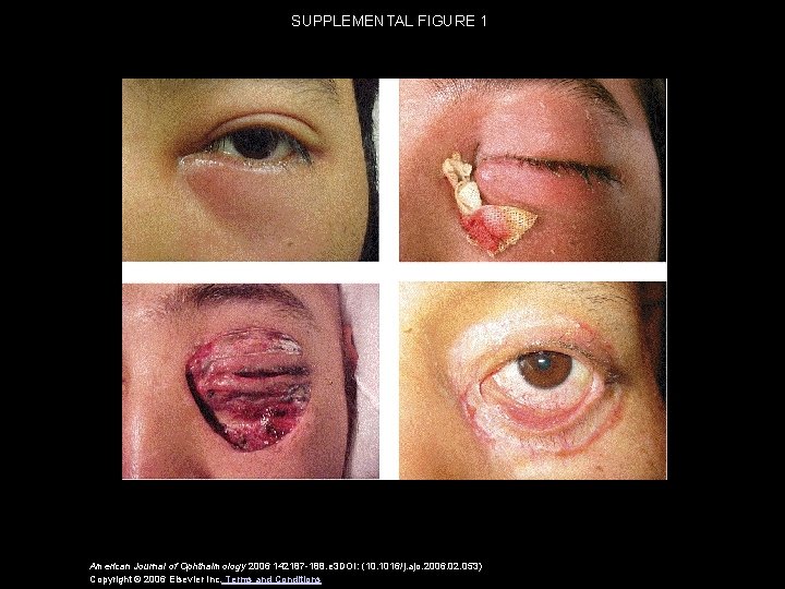 SUPPLEMENTAL FIGURE 1 American Journal of Ophthalmology 2006 142187 -188. e 3 DOI: (10.