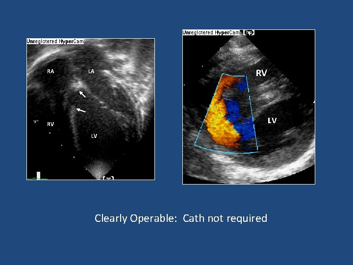 RA RV LA LV RV LV Clearly Operable: Cath not required 