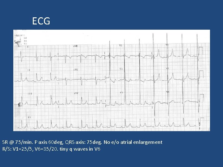 ECG SR @ 75/min. P axis 60 deg, QRS axis: 75 deg. No e/o