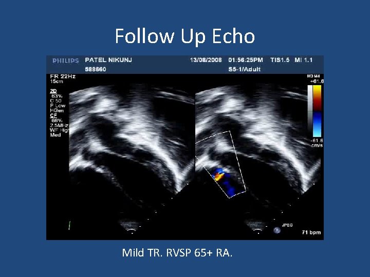 Follow Up Echo Small Fenestration in VSD patch L->R Mild TR. RVSP 65+ RA.