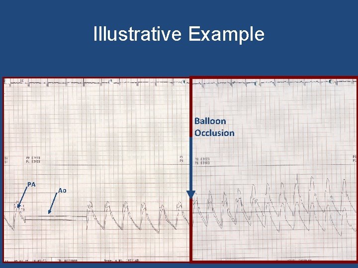 Illustrative Example Balloon Occlusion PA Ao 