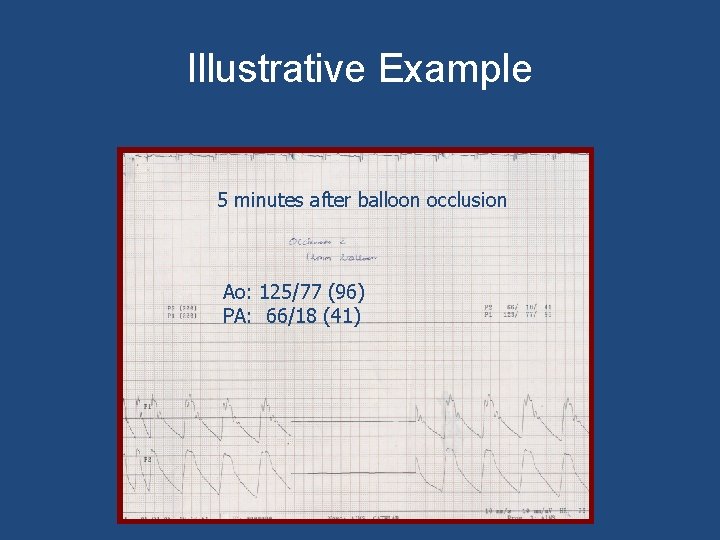 Illustrative Example 5 minutes after balloon occlusion Ao: 125/77 (96) PA: 66/18 (41) 