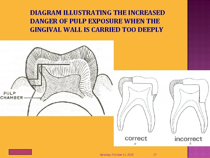 DIAGRAM ILLUSTRATING THE INCREASED DANGER OF PULP EXPOSURE WHEN THE GINGIVAL WALL IS CARRIED