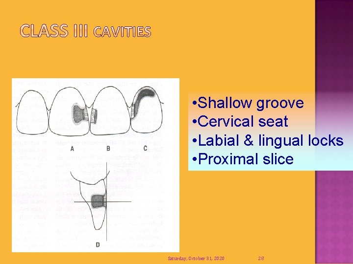  • Shallow groove • Cervical seat • Labial & lingual locks • Proximal