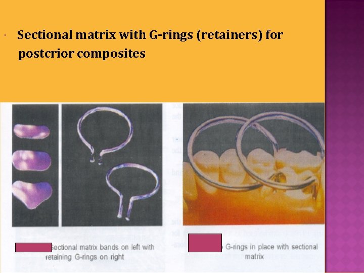  Sectional matrix with G-rings (retainers) for postcrior composites Saturday, October 31, 2020 40