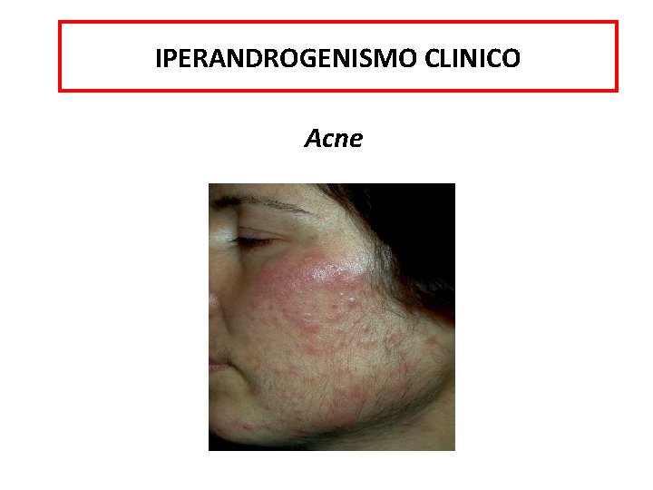 IPERANDROGENISMO CLINICO Acne 