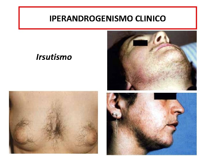 IPERANDROGENISMO CLINICO Irsutismo 