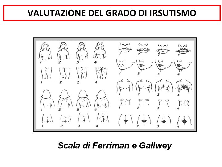 VALUTAZIONE DEL GRADO DI IRSUTISMO Scala di Ferriman e Gallwey 