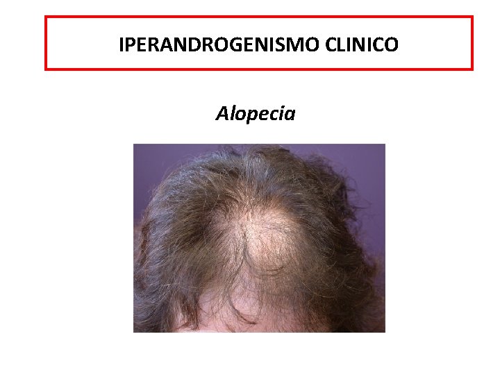 IPERANDROGENISMO CLINICO Alopecia 