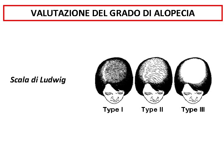 VALUTAZIONE DEL GRADO DI ALOPECIA Scala di Ludwig 