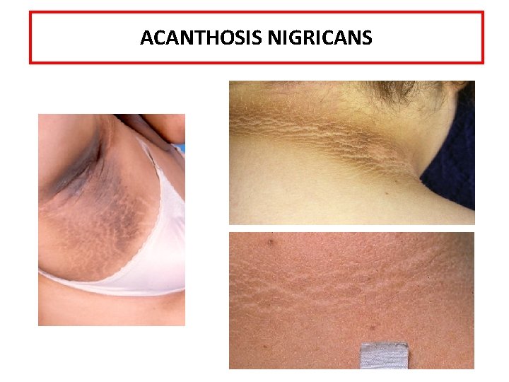 ACANTHOSIS NIGRICANS 