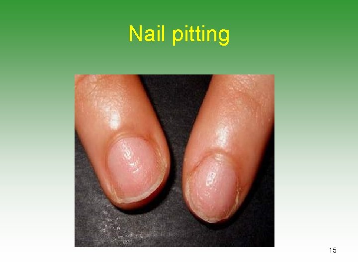Nail pitting 15 