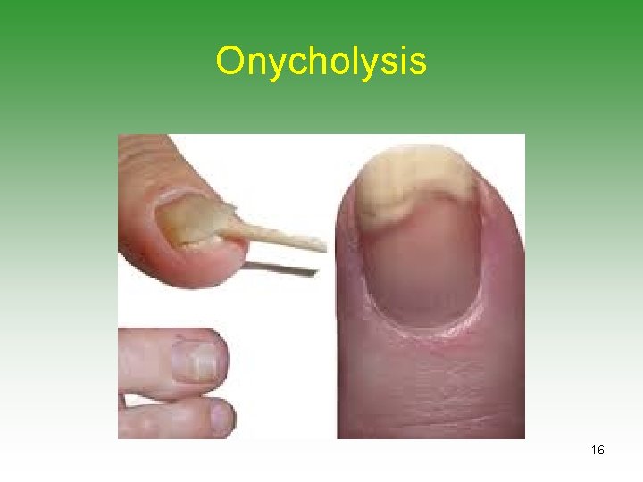 Onycholysis 16 