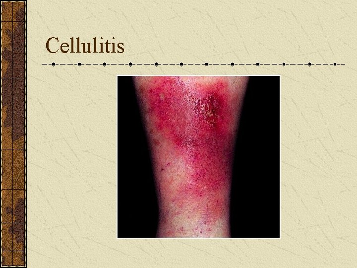 Cellulitis 