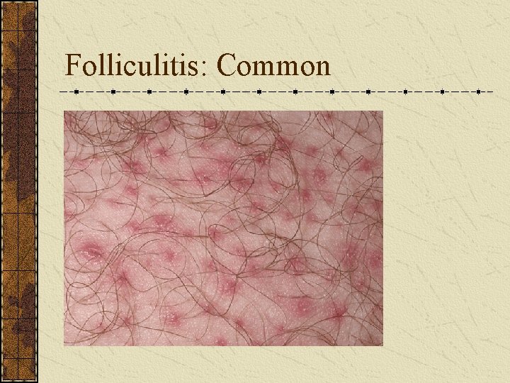 Folliculitis: Common 