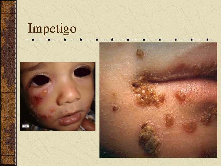 Impetigo 