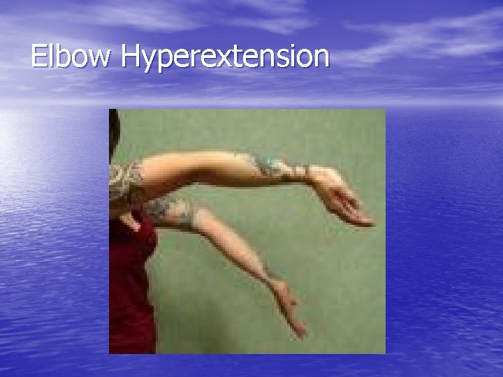 Elbow Hyperextension 