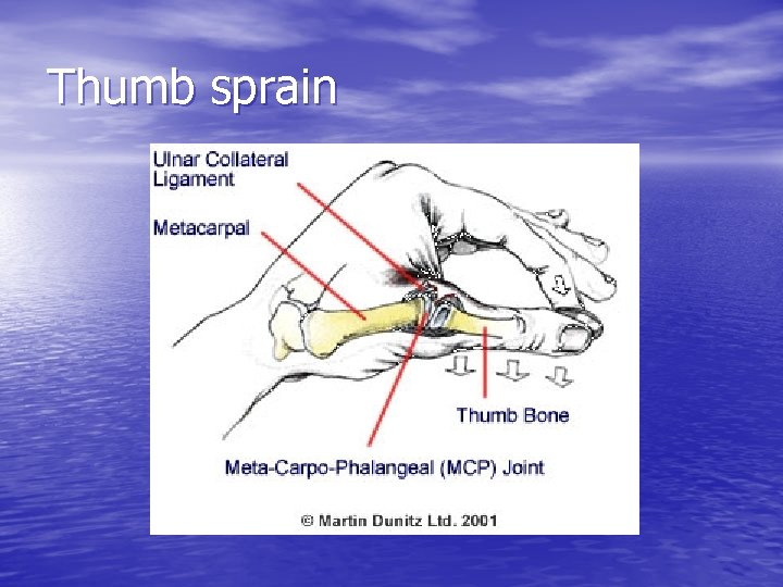 Thumb sprain 