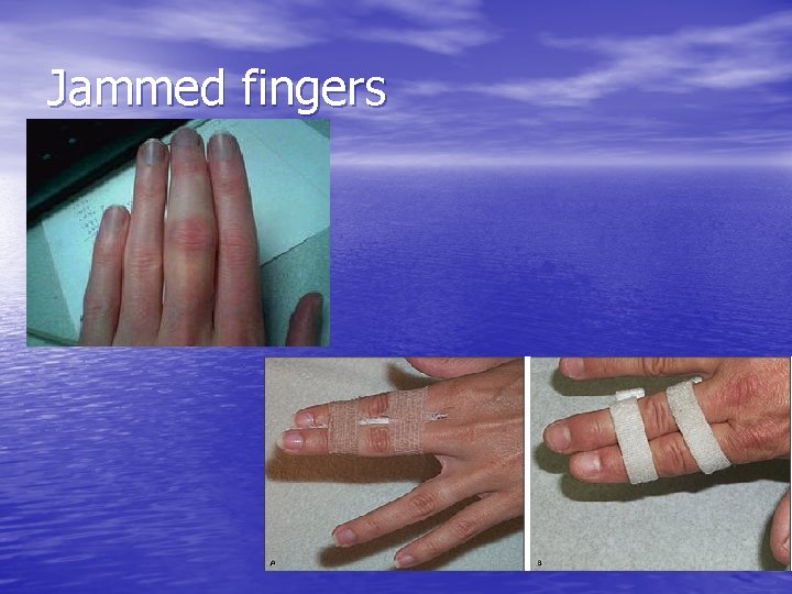 Jammed fingers 