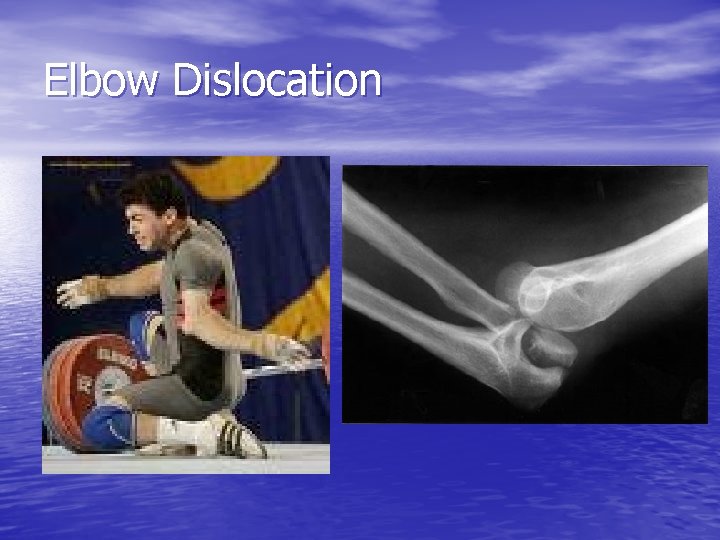 Elbow Dislocation 