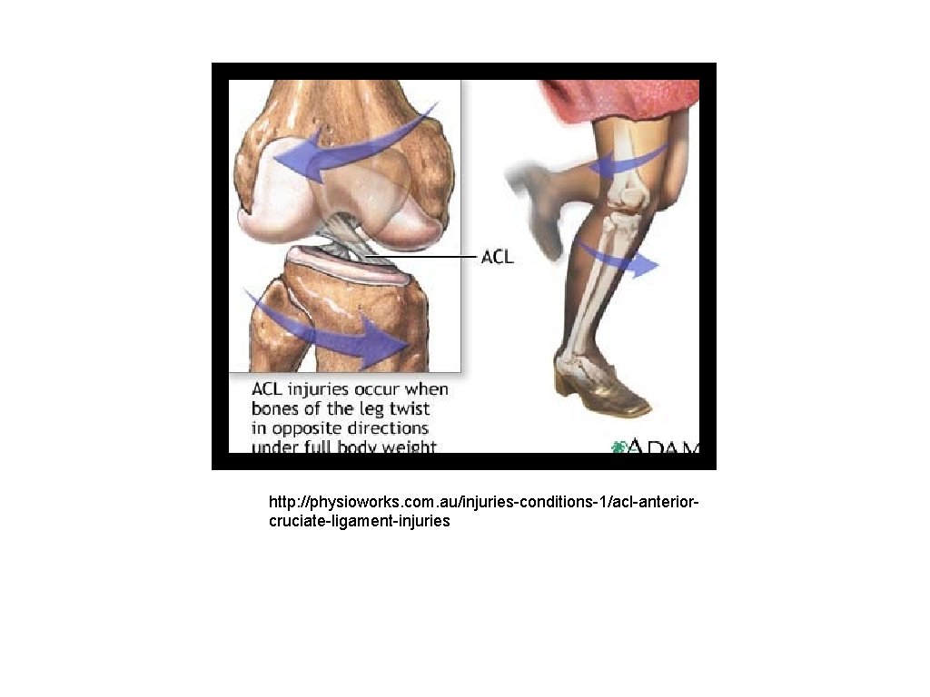 http: //physioworks. com. au/injuries-conditions-1/acl-anteriorcruciate-ligament-injuries 