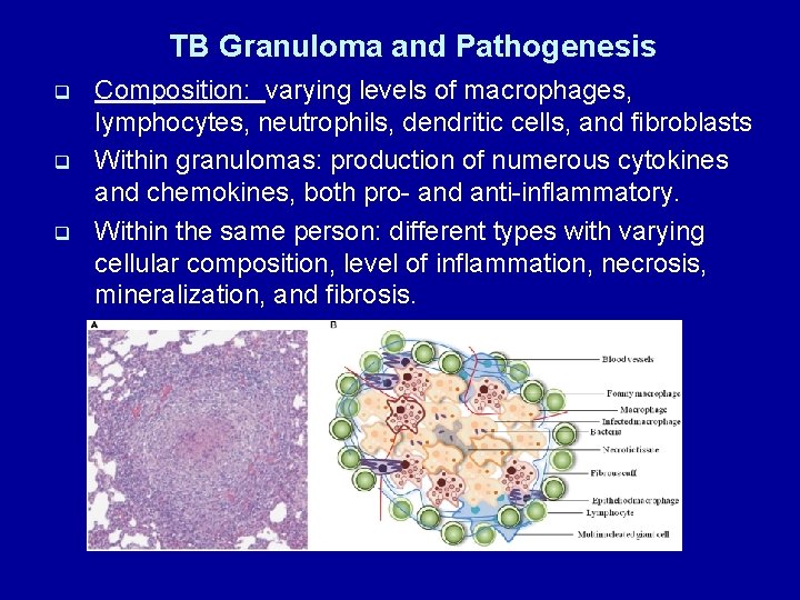 TB Granuloma and Pathogenesis q q q Composition: varying levels of macrophages, lymphocytes, neutrophils,