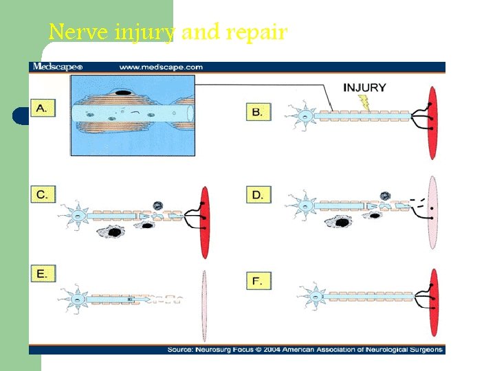 Nerve injury and repair 