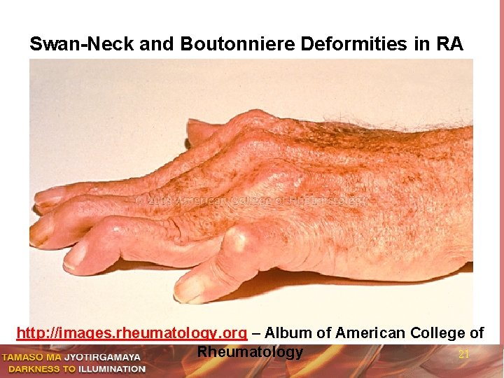 Swan-Neck and Boutonniere Deformities in RA http: //images. rheumatology. org – Album of American