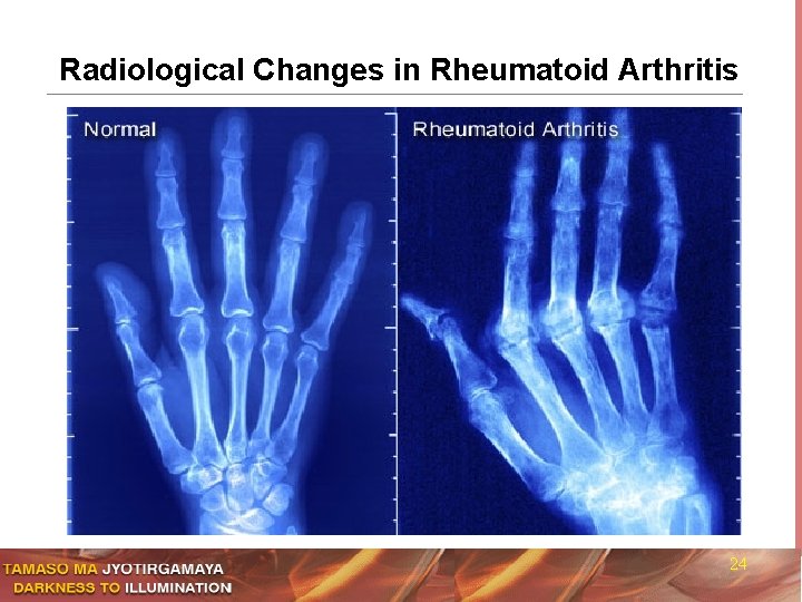 Radiological Changes in Rheumatoid Arthritis 24 