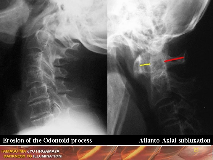 Erosion of the Odontoid process Atlanto-Axial subluxation 25 