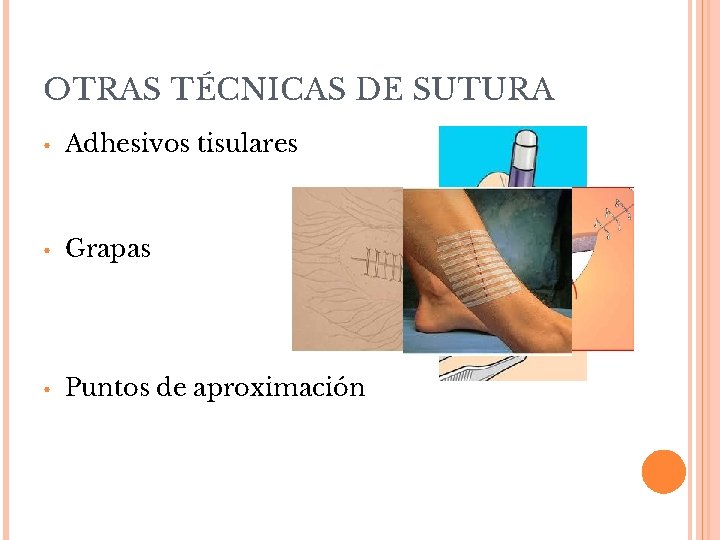 OTRAS TÉCNICAS DE SUTURA • Adhesivos tisulares • Grapas • Puntos de aproximación 