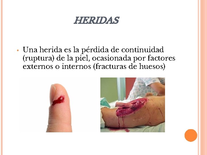 HERIDAS • Una herida es la pérdida de continuidad (ruptura) de la piel, ocasionada