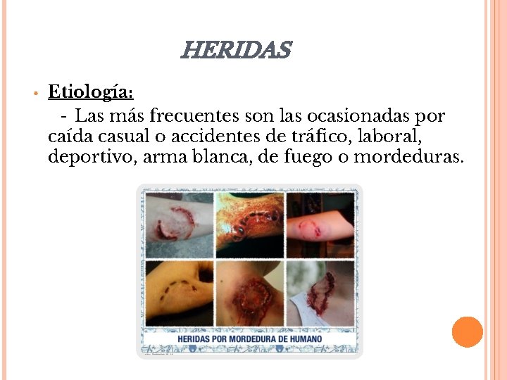 HERIDAS • Etiología: - Las más frecuentes son las ocasionadas por caída casual o