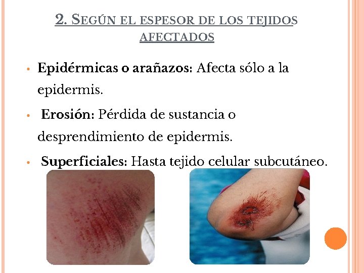 2. SEGÚN EL ESPESOR DE LOS TEJIDOS AFECTADOS • Epidérmicas o arañazos: Afecta sólo