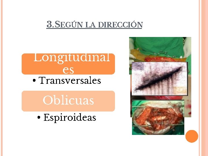 3. SEGÚN LA DIRECCIÓN Longitudinal es • Transversales Oblicuas • Espiroideas 
