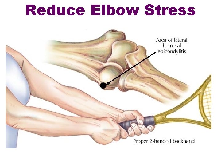 Reduce Elbow Stress 