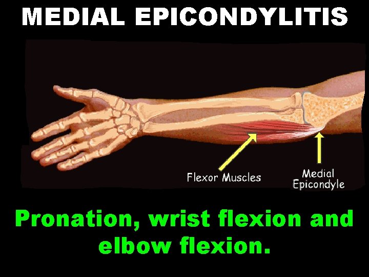 MEDIAL EPICONDYLITIS Pronation, wrist flexion and elbow flexion. 