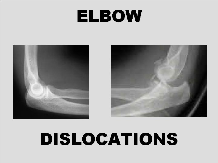 ELBOW DISLOCATIONS 