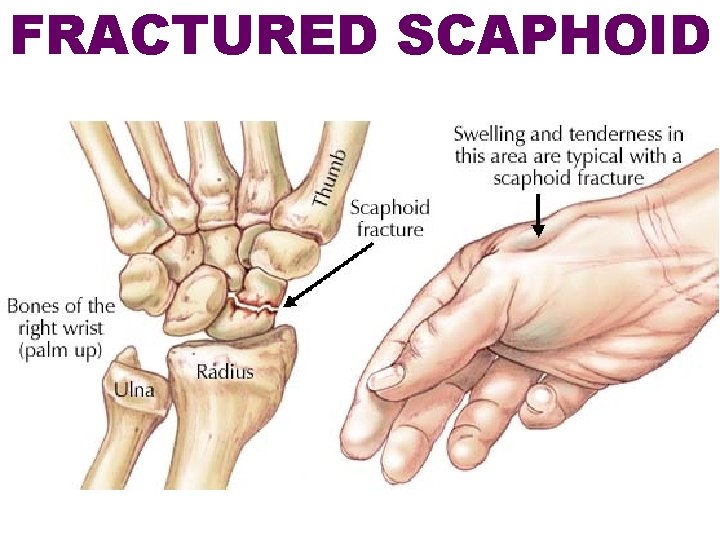 FRACTURED SCAPHOID 