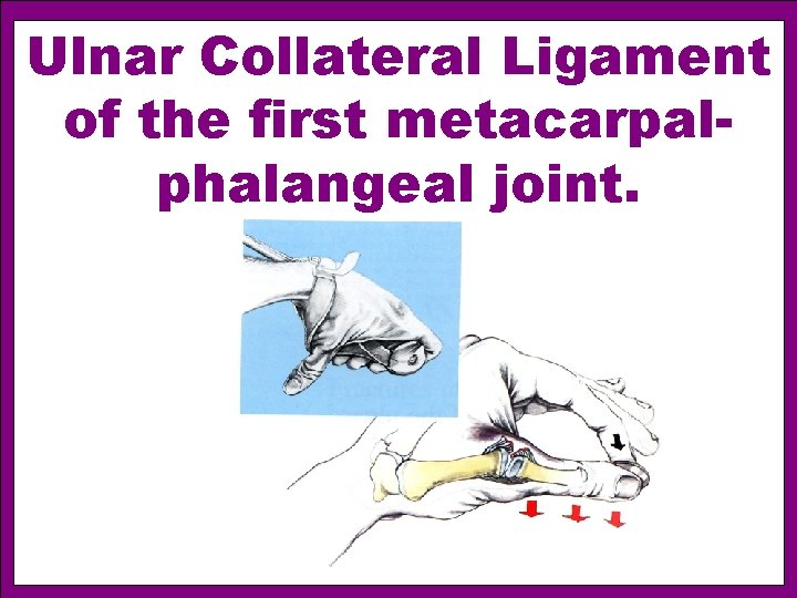 Ulnar Collateral Ligament of the first metacarpalphalangeal joint. 