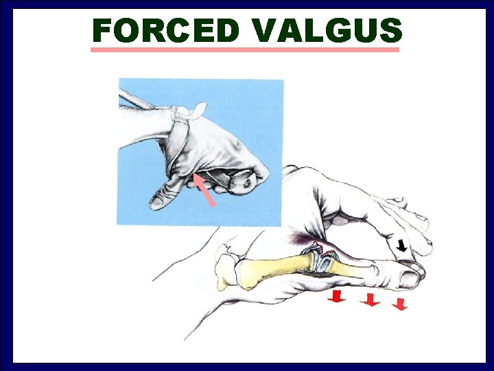 FORCED VALGUS 