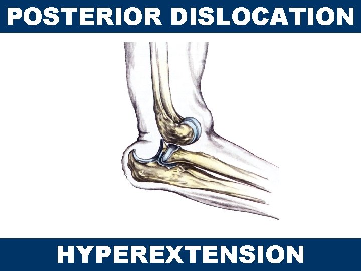 POSTERIOR DISLOCATION HYPEREXTENSION 