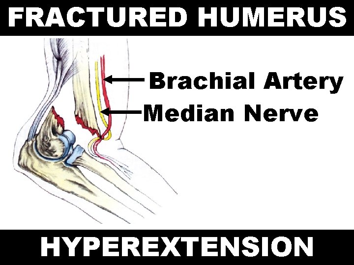FRACTURED HUMERUS Brachial Artery Median Nerve HYPEREXTENSION 