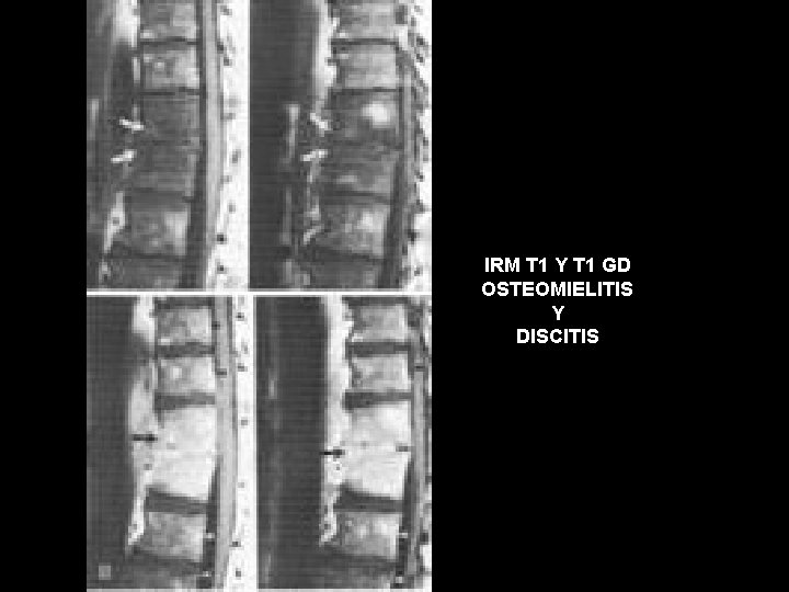 IRM T 1 Y T 1 GD OSTEOMIELITIS Y DISCITIS 