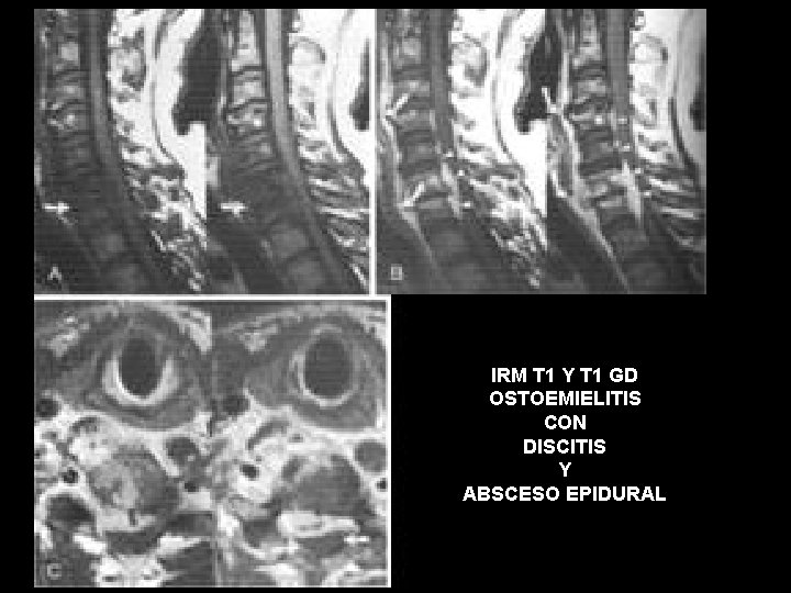 IRM T 1 Y T 1 GD OSTOEMIELITIS CON DISCITIS Y ABSCESO EPIDURAL 