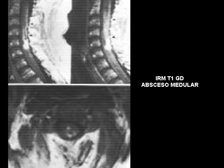 IRM T 1 GD ABSCESO MEDULAR 