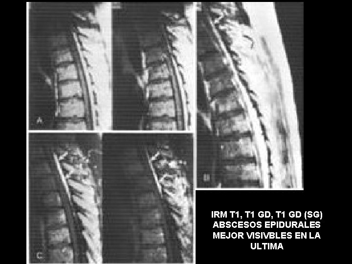 IRM T 1, T 1 GD (SG) ABSCESOS EPIDURALES MEJOR VISIVBLES EN LA ULTIMA