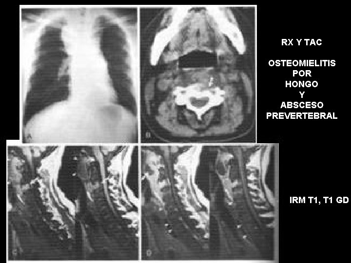 RX Y TAC OSTEOMIELITIS POR HONGO Y ABSCESO PREVERTEBRAL IRM T 1, T 1
