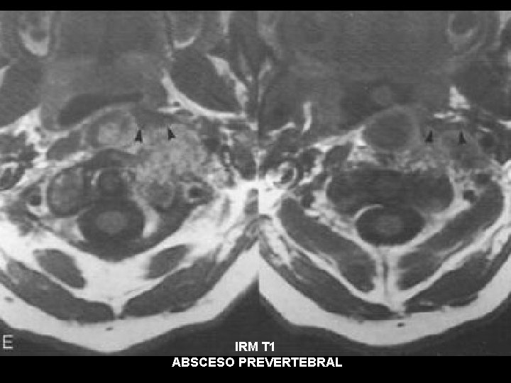 IRM T 1 ABSCESO PREVERTEBRAL 